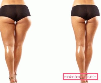 Antes y después de la corrección de figuras por mesoteropy. Antes y después de la corrección de figuras por mesoteropy.